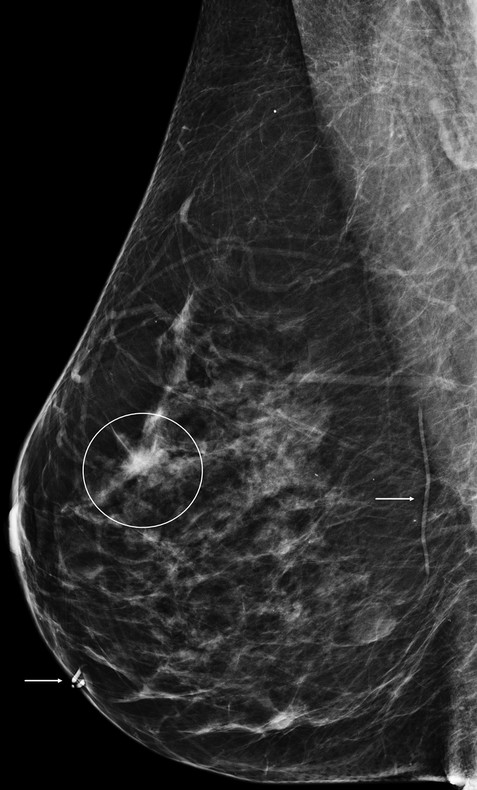 Possible Architectural Distortion | Radiology Key