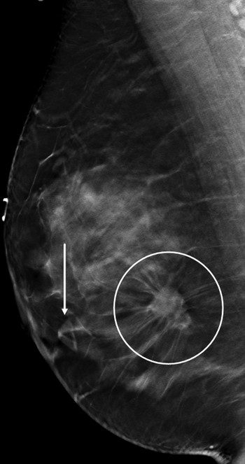 Architectural Distortion | Radiology Key