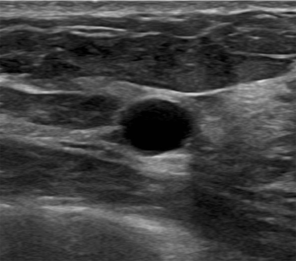 Mass with Architectural Distortion Radiology Key