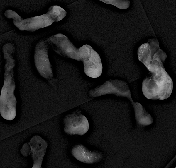 Grouped Amorphous Calcifications | Radiology Key