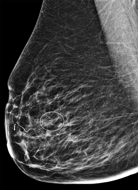 Increased Breast Density Radiology Key