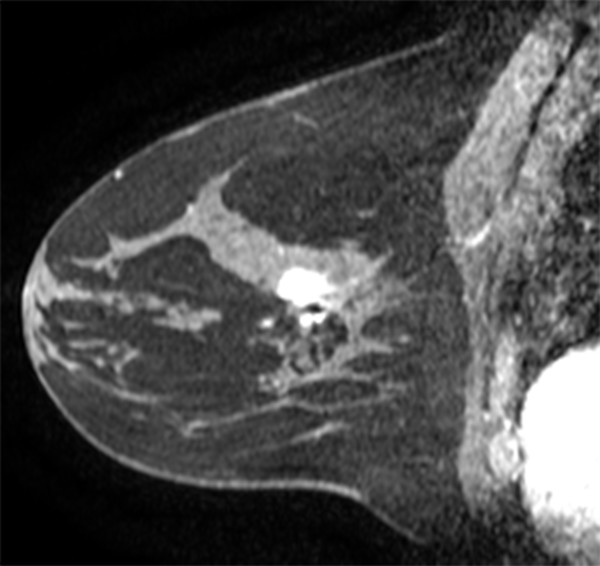 Architectural Distortion | Radiology Key