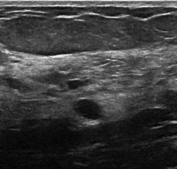 Obscured mass radiology key