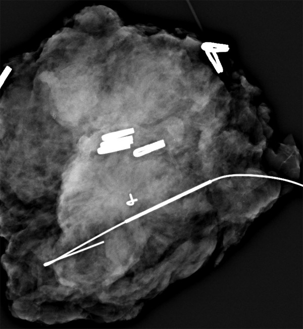 Architectural Distortion Radiology Key