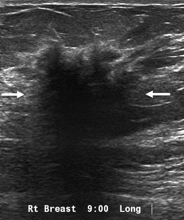 Palpable Axillary Mass | Radiology Key