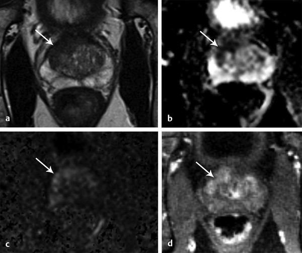 Introduction to Prostate Cancer: Clinical Considerations | Radiology Key