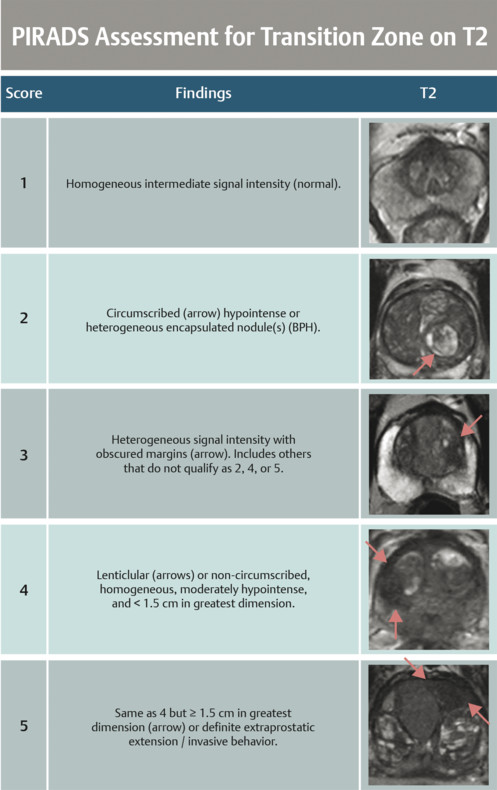 Diffuse Peripheral Zone T2 Hypointensity When To Worry About XYTKFB Diffuse Peripheral Zone T2 Hypointensity When To Worry About XYTKFB