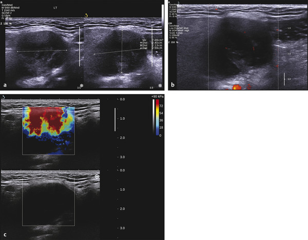 Elastography of the Salivary Glands, Lymph Nodes, and Testes ...