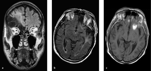 Head Trauma | Radiology Key