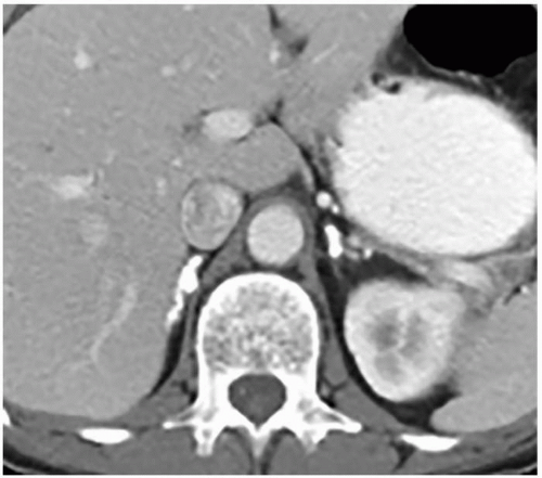 The Adrenal Gland Radiology Key 3526