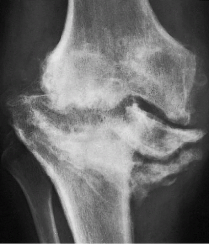 Degenerative Joint Diseases | Radiology Key