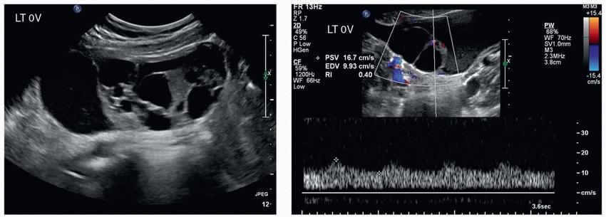 Intrauterine blood clot  Radiology Reference Article