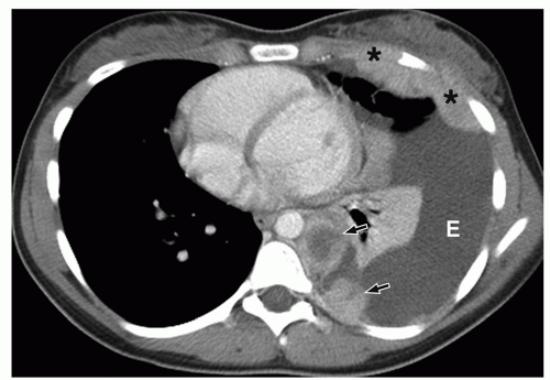 Pleura | Radiology Key