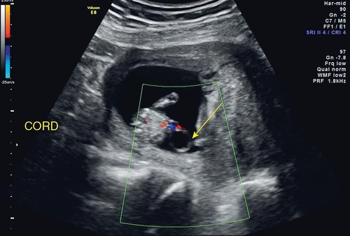 First Trimester Pregnancy Radiology Key 