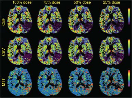 Dose Considerations in CT Perfusion | Radiology Key