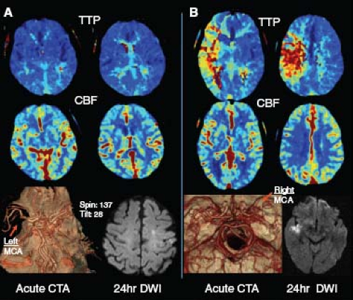 The Role Of Multimodal Brain Imaging In Clinical Stroke Trials ...