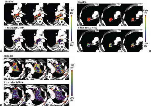 Lung Cancer | Radiology Key