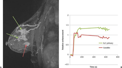 Breast Cancer | Radiology Key