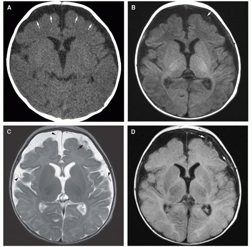 Infections of the Developing and Mature Nervous System | Radiology Key