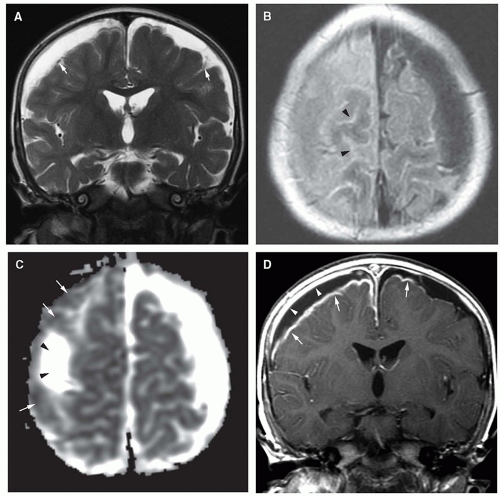 Infections of the Developing and Mature Nervous System | Radiology Key