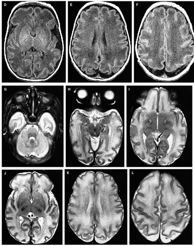 Normal Development of the Fetal, Neonatal, and Infant Brain, Skull, and ...