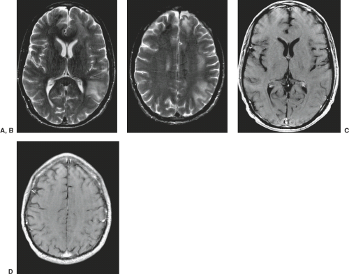 Intracranial Infection | Radiology Key