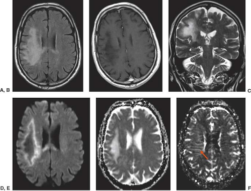 Intracranial Infection | Radiology Key