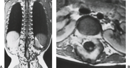 Congenital Anomalies Of The Spine And Spinal Cord: Embryology And ...