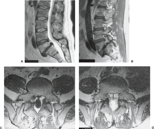 Degenerative Disease of the Spine | Radiology Key