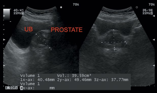 Skin (Cellulitis) and Soft Tissue | Radiology Key