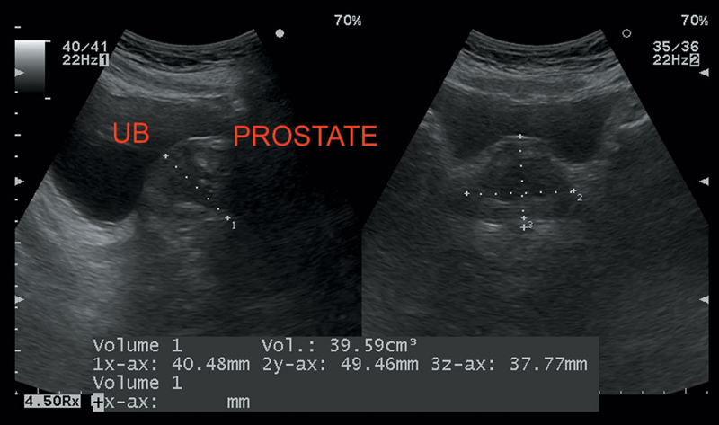Prostate Ultrasound Scan
