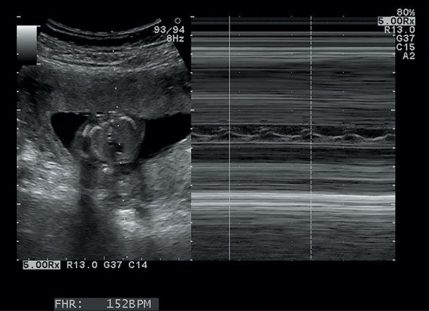 Third Trimester | Radiology Key