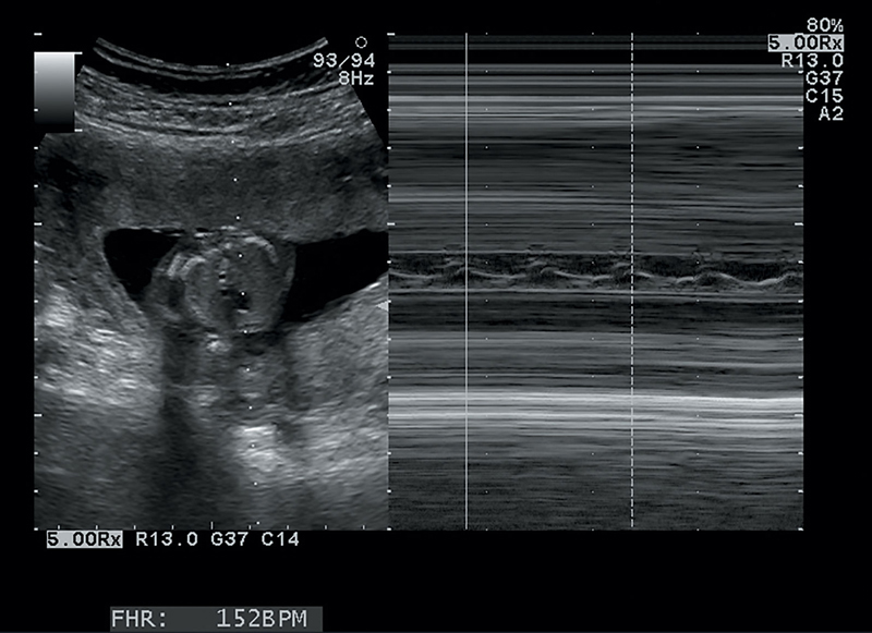 Second Trimester | Radiology Key