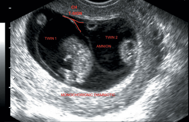 Multifetal Pregnancy Radiology Key 4291