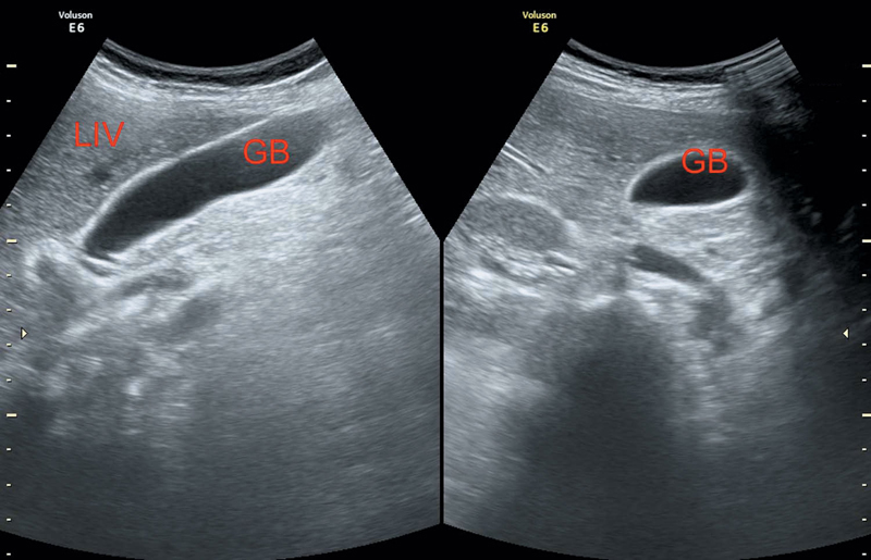 Wall-echo-shadow sign (ultrasound), Radiology Reference Article