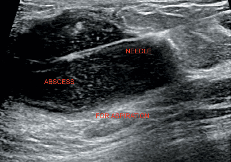 USG-Guided Interventions | Radiology Key