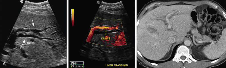 Dilated Bile Ducts Radiology Key 