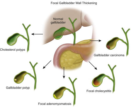 Focal Gallbladder Wall Thickening | Radiology Key
