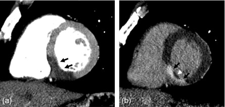 Myocardial infarction | Radiology Key