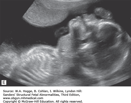 cleft palate ultrasound profile