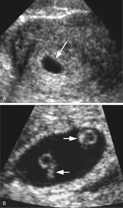 Week Transvaginal Ultrasound