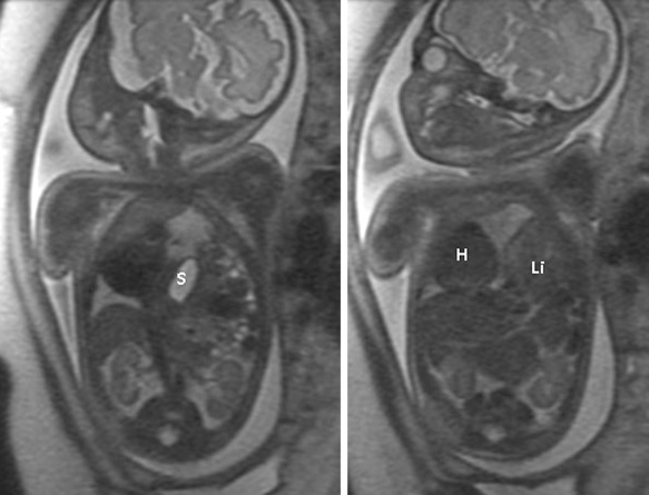 Ultrasound Evaluation of the Fetal Thorax | Radiology Key