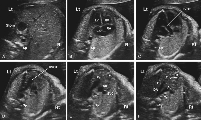Fetal Lvot Ultrasound