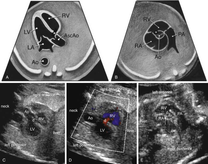 Fetal Heart Anatomy Ultrasound PHOTO GALLERY What Does Fetal Medical Fetal Heart Anatomy Ultrasound PHOTO GALLERY What Does Fetal Medical