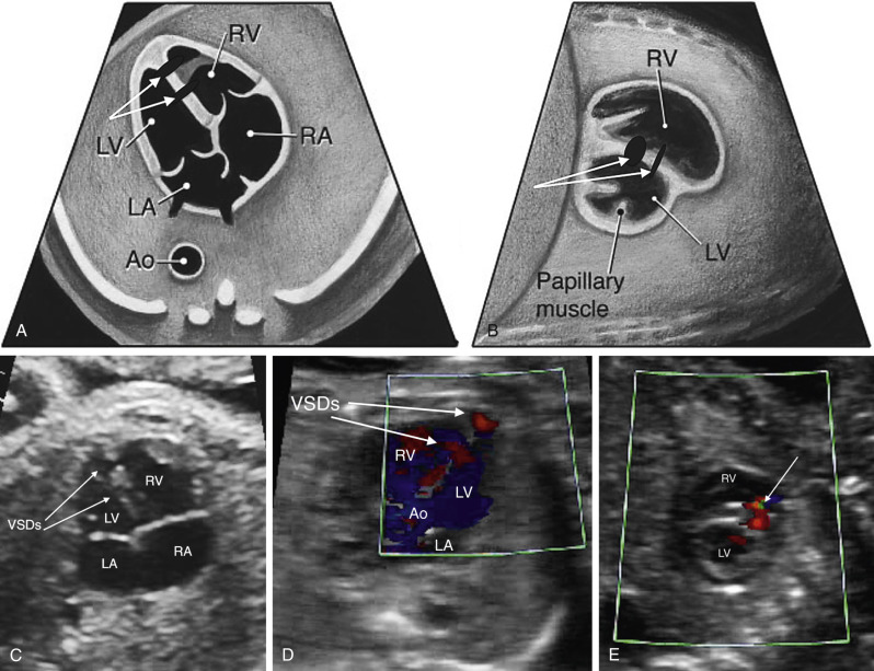 Sonographic Evaluation of the Fetal Heart | Radiology Key