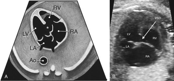 Sonographic Evaluation of the Fetal Heart | Radiology Key