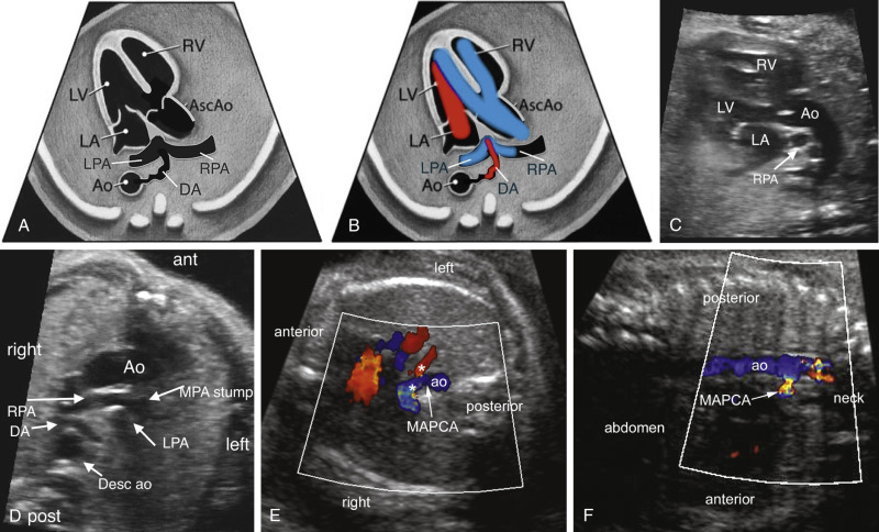 Fetal Heart Ultrasound Early Birth MAXLUA Fetal Heart Ultrasound Early Birth MAXLUA