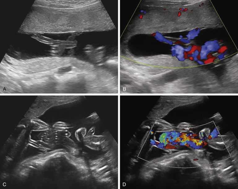 Succenturiate vs bilobed placenta gestational diabetes ethereum mist disk capacity