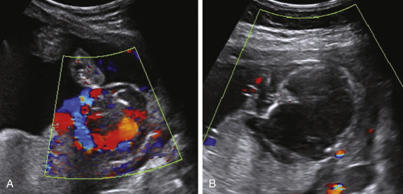 Role of Sonography in Fetal Procedures | Radiology Key