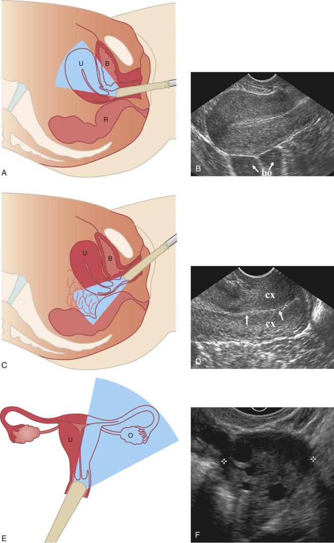 Ultrasound Of The Pelvis Shows A Normal Uterus